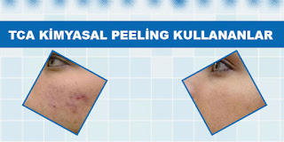 TCA Kimyasal Peeling Kullananlar TCA Kimyasal Peeling Kullananlar
