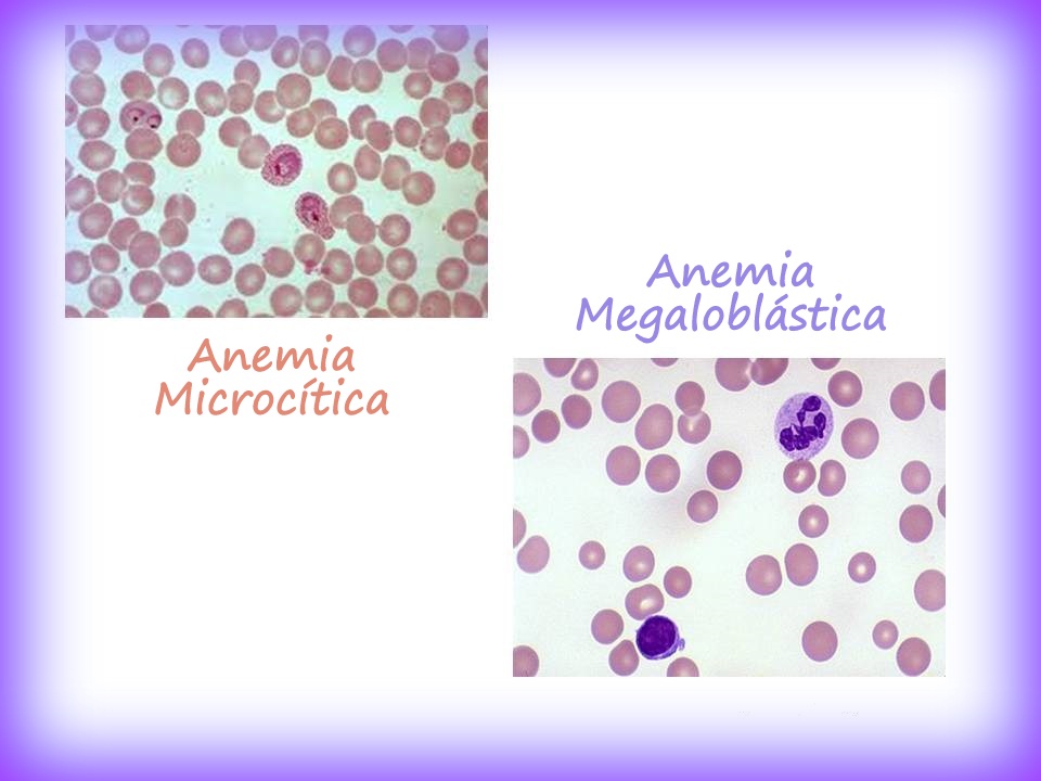 anemia megaloblastica caracteristicas clinicas anemia megaloblastica caracteristicas clinicas