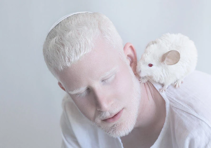 Albinism in Humans and Animals
