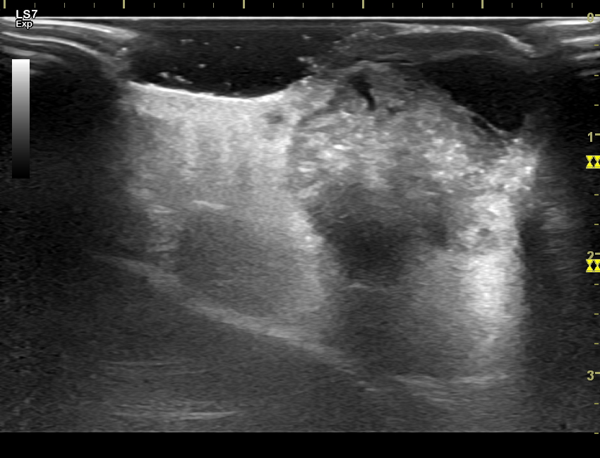 VIETNAMESE MEDIC ULTRASOUND CASE 441 LIKE CHERRY SKIN TUMOR, Dr PHAN