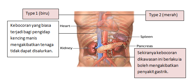 Rawatan kencing manis: Diabetes, Luka Dalaman, Gastrik Dan 