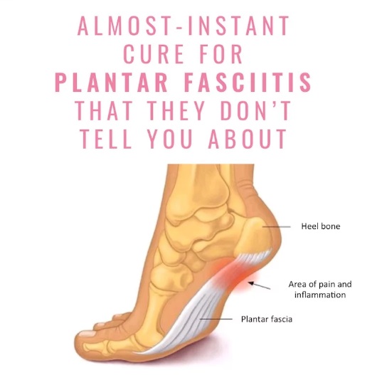 ALMOSTINSTANT CURE FOR PLANTAR FASCIITIS THAT THEY DON’T