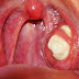 HOW TO CURE TONSILLITIS AND SORE THROAT IN ONLY 4 HOURS!
