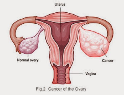 Ciri-ciri kanker ovarium