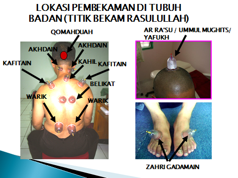 Perubatan Produk Muslim & Urutan Tradisional: BEKAM ANGIN 