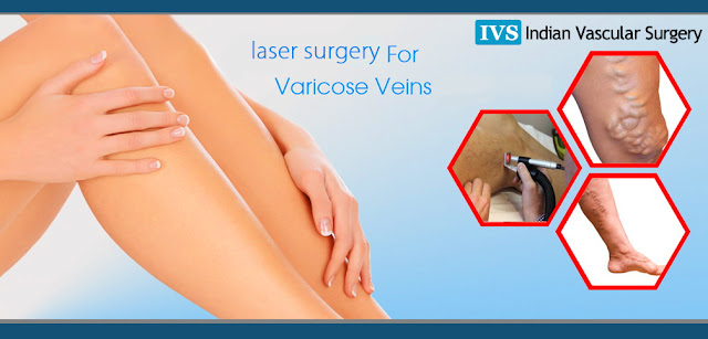 Laser Surgery For Varicose Vein