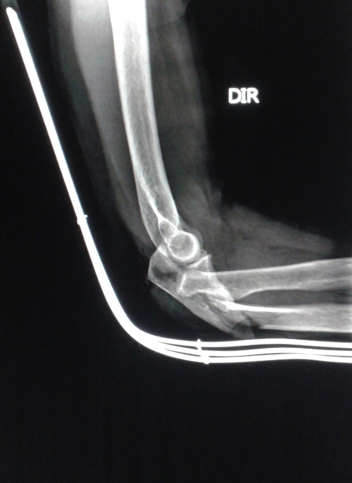 DICAS DE RADIOLOGIA Tudo Sobre Radiologia IMAGENS RADIOLÓGICAS FRATURA ULNA COTOVELO DICAS DE RADIOLOGIA Tudo Sobre Radiologia IMAGENS RADIOLÓGICAS FRATURA ULNA COTOVELO