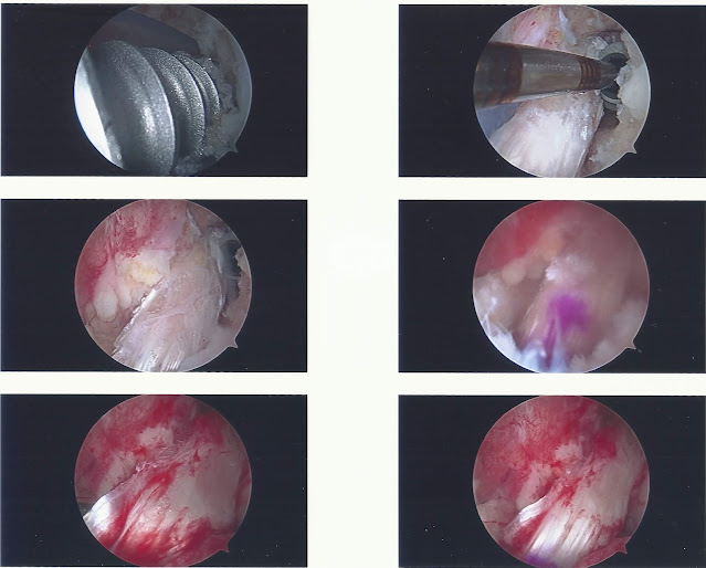 arthroscope snapshots showing tap threads and tendon tissue