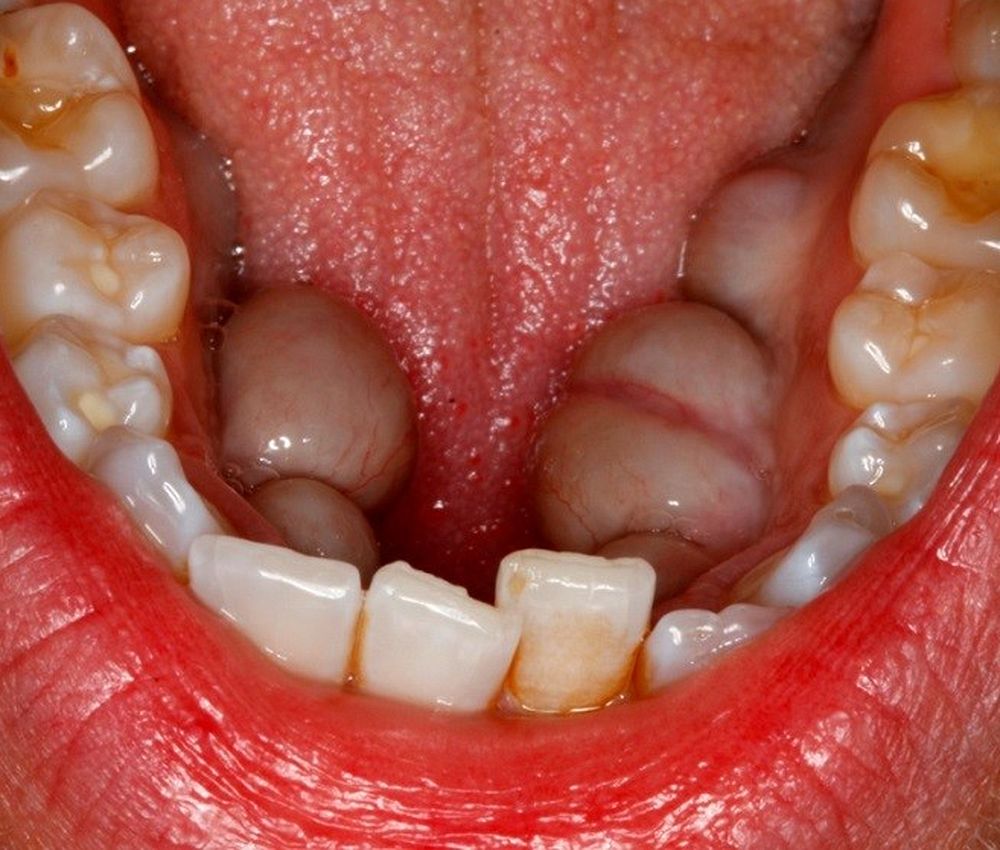 ORAL PATHOLOGY : What are mandibular tori? | Directorio Odontológico