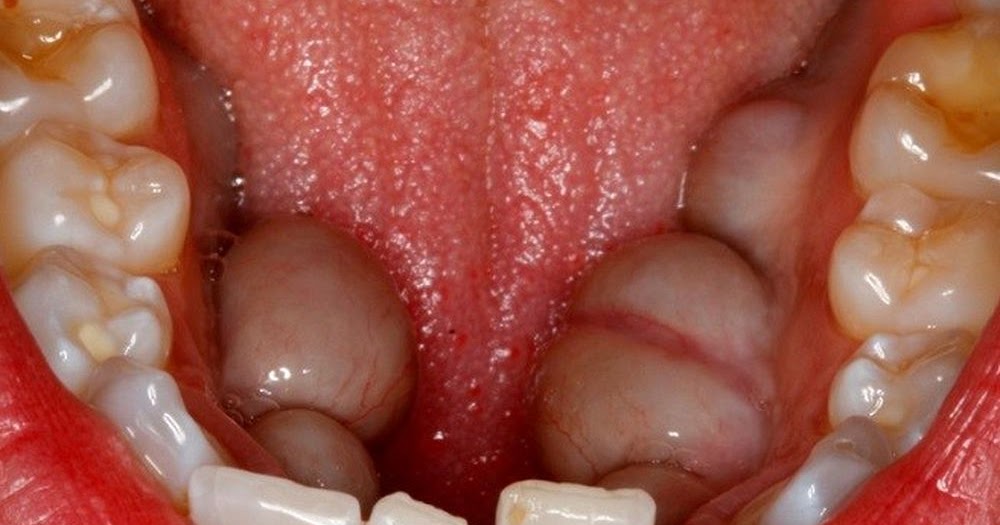 ORAL PATHOLOGY What are mandibular tori? Directorio Odontológico