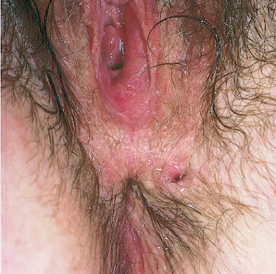 Chronic rectal fistula with secondary gonococcal infection of the fistula tract.  