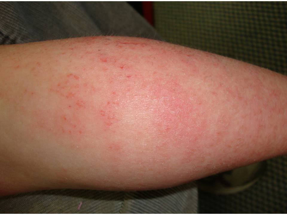 Consultations in Dermatology The Rash that itches Atopic Dermatitis
