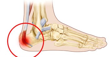 what is apophysitis definition