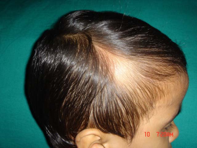 гнёздная (очаговая алопеция). маленькая лысина на голове. гнездовая алопеция у детей. гнездная алопеция у детей. алопеция гнездная волос.