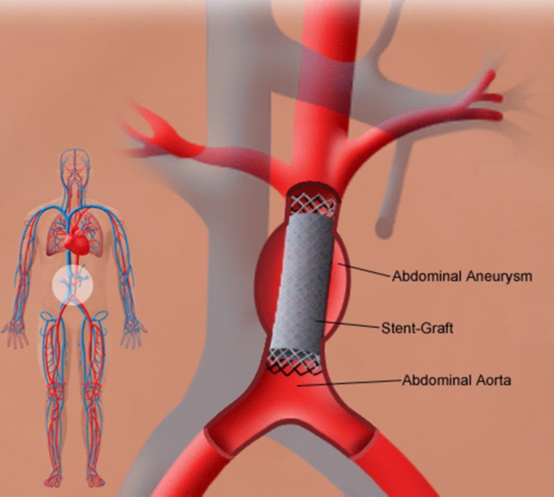 Аневризма вен Аневризма вен