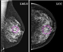 Diagnostic mammography