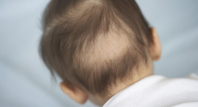 嬰兒姑路： 6個月的小寶寶頭的後面與側面大量掉髮
