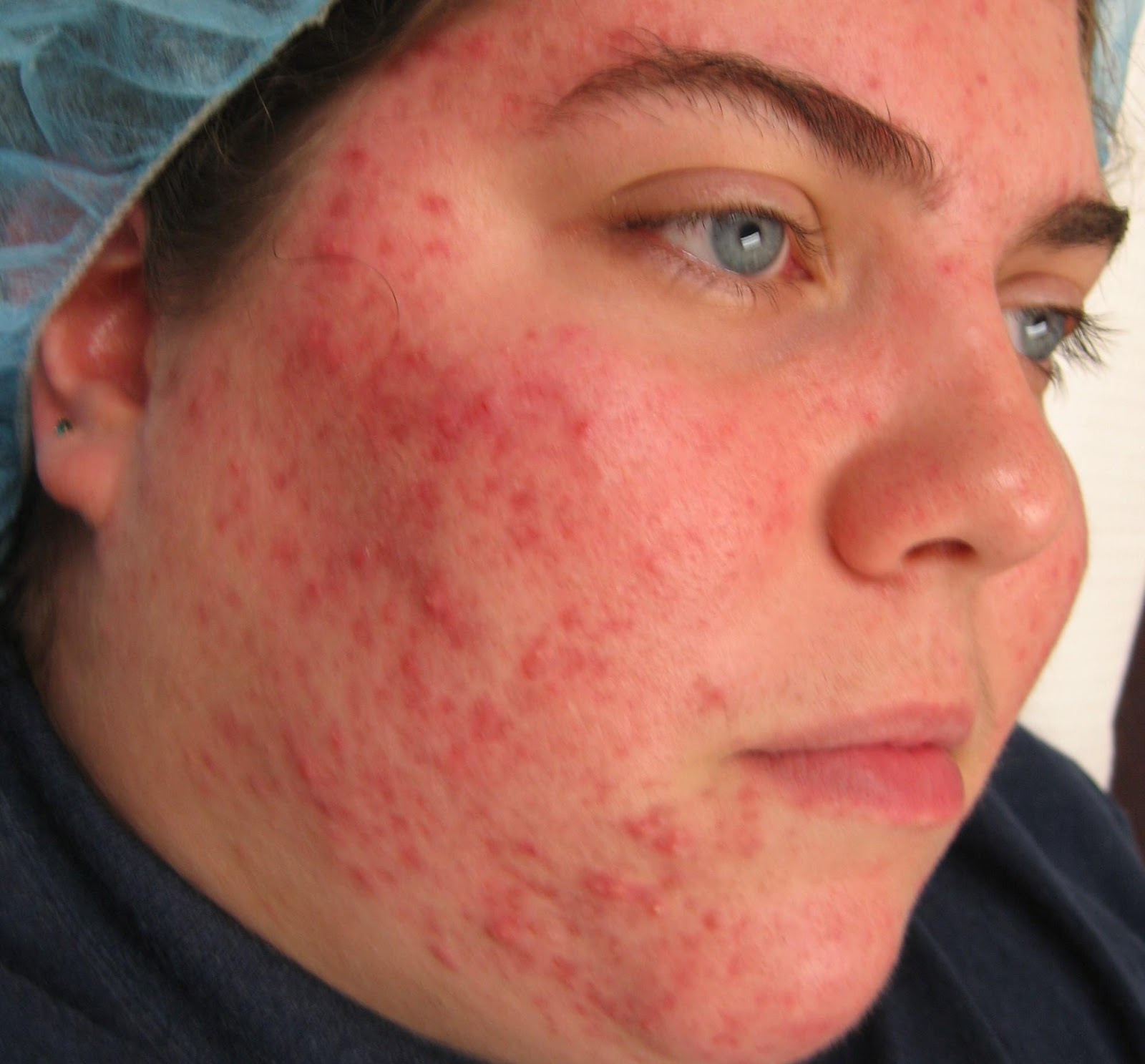 Best Acne Scars Treatment Products Acne Tips and Natural Acne Scar Removal Products