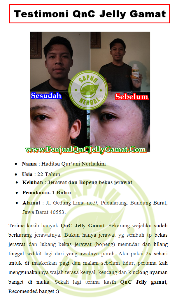 Obat Jerawat Batu Yang Dioles, Salep AMPUH Menyembuhkan Jerawat Batu / Acne conglobata Secara Alami Obat Jerawat Batu Yang Dioles, Salep AMPUH Menyembuhkan Jerawat Batu / Acne conglobata Secara Alami