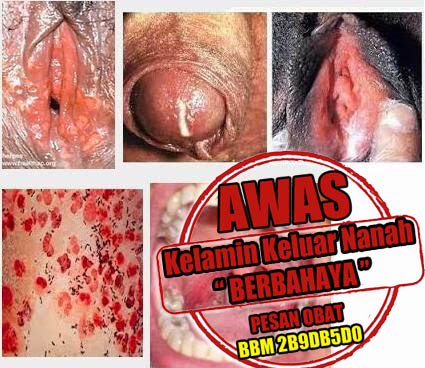 Obat Kencing Nanah Yang Murah Pengobatan 3 - 5 Hari Sembuh Obat Kencing Nanah Yang Murah Pengobatan 3 - 5 Hari Sembuh