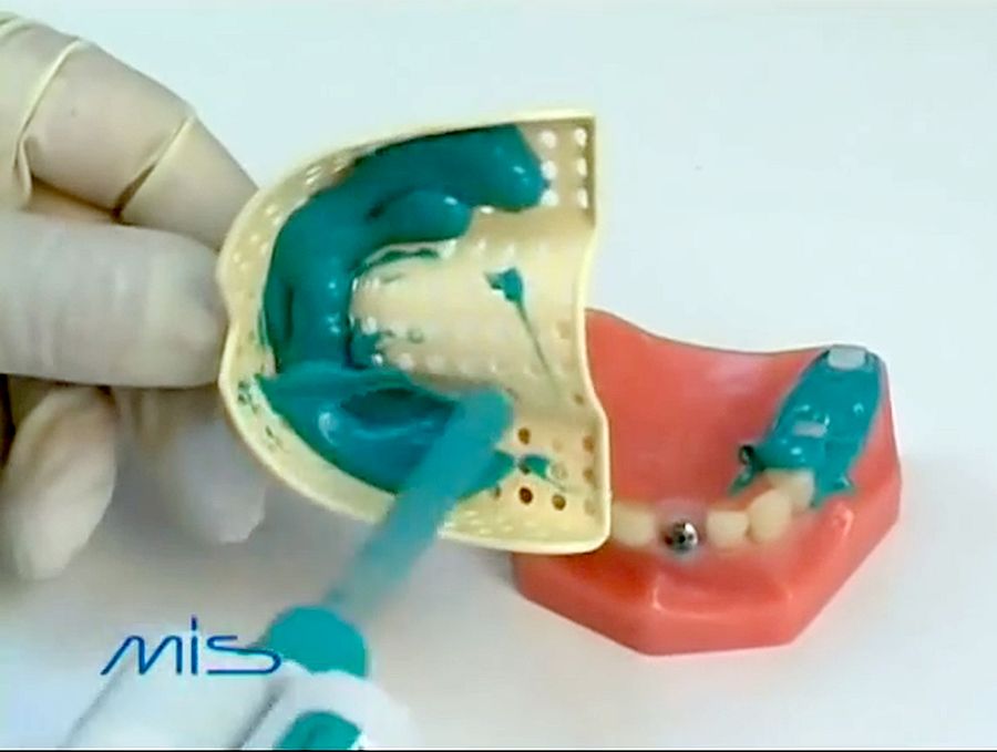 IMPLANTOLOGY Dental Implant Impression Techniques MIS