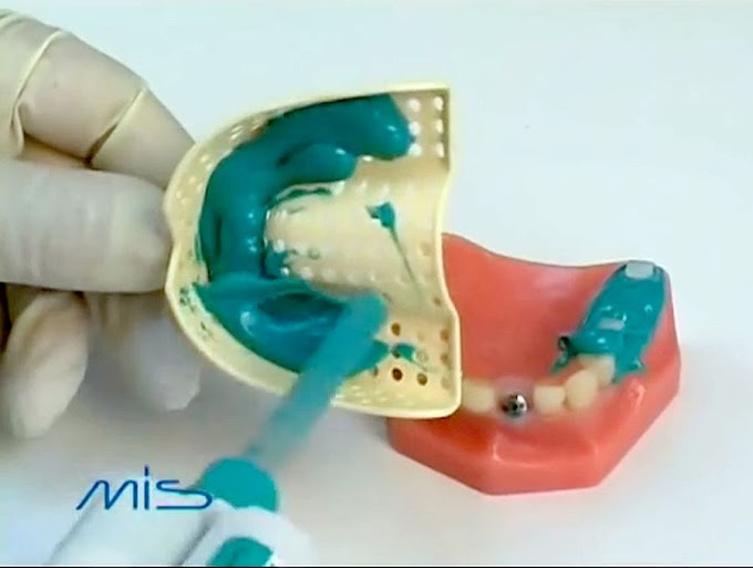 IMPLANTOLOGY: Dental Implant Impression Techniques MIS