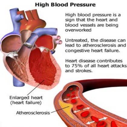 How does sodium raise blood pressure