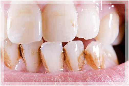 teeth tartar