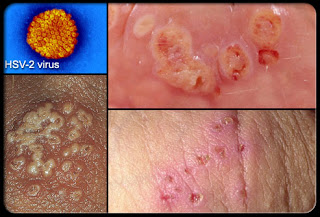 Obat Herpes Simplex Virus Type 2