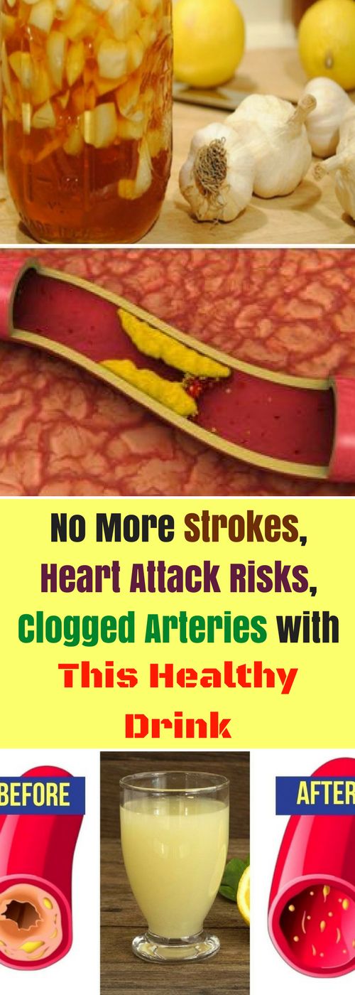 No More Strokes, Heart Attack Risks, Clogged Arteries with This Healthy