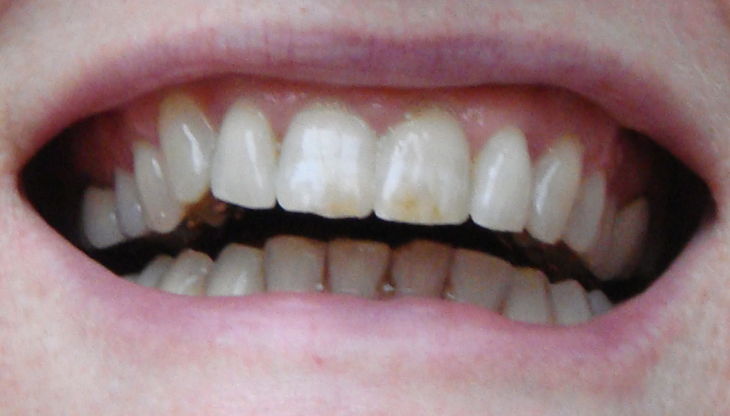Braces at 56 First Night with Clear Retainer on Bottom Teeth