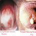 Apat itu penyakit Kencing Nanah atau gonore? thumbnail