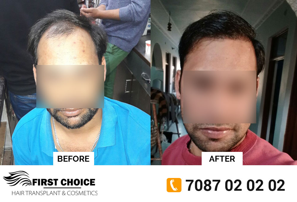 Patient's Hair Growth Evolution from 0 to 9 months after Hair Transpla...