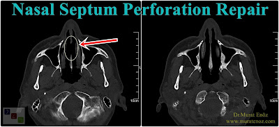 Cost of septum perforation surgery in Turkey - Cost of septum perforation surgery in İstanbul - Cost of nasal septum perforation repair in İstanbul - How much is a septal perforation surgery in İstanbul? - How much is a septal perforation surgery in Turkey? - Surgical treatment of nasal septal perforations rpice in İstanbul - Surgical treatment of nasal septal perforations rpice in Turkey - Nasal septal perforation surgery cost in İstanbul