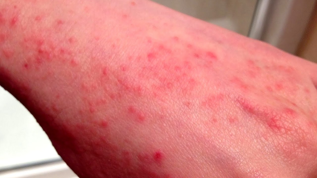 Steroids For Allergies Side Effects Effect Choices