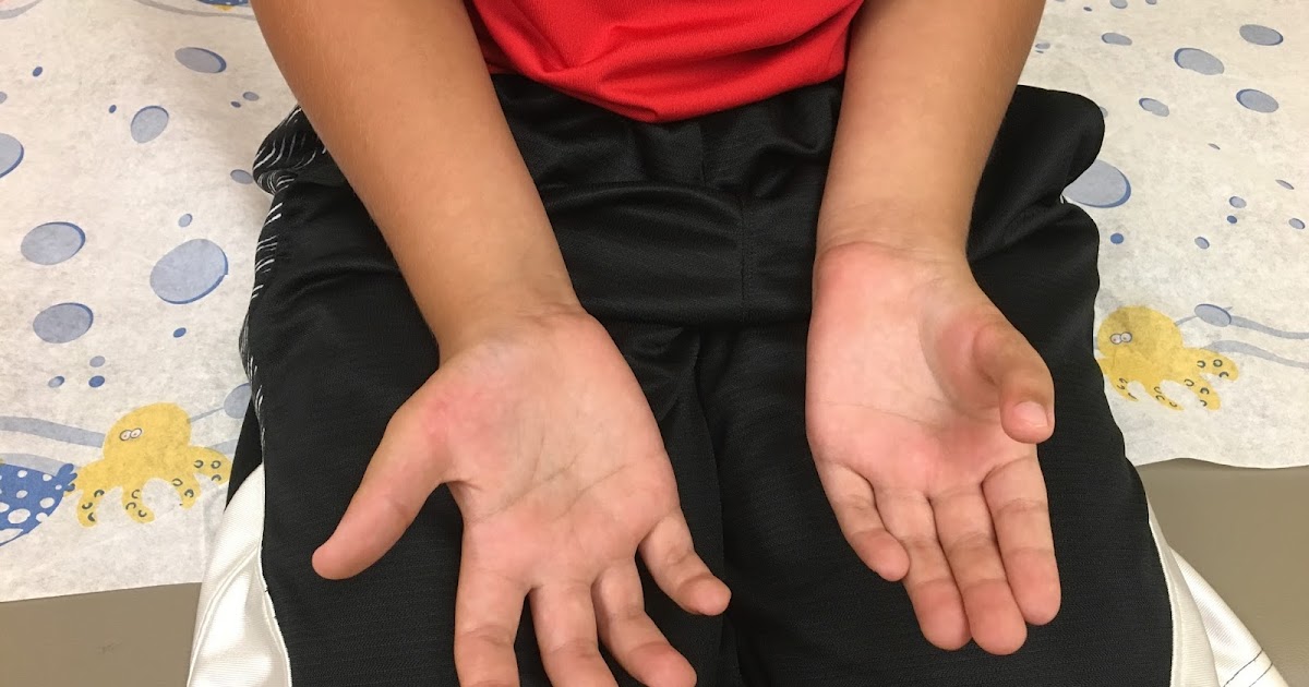 Thumb Reconstruction in Action Congenital Hand and Arm Differences