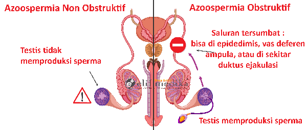 Azoospermia obstruktif dan azoospermia non obstruktif