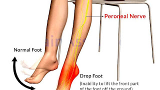 Foot drop