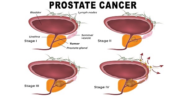 How to Kill Prostate and Ovarian Cancer With Just One Root! - Misfit ...