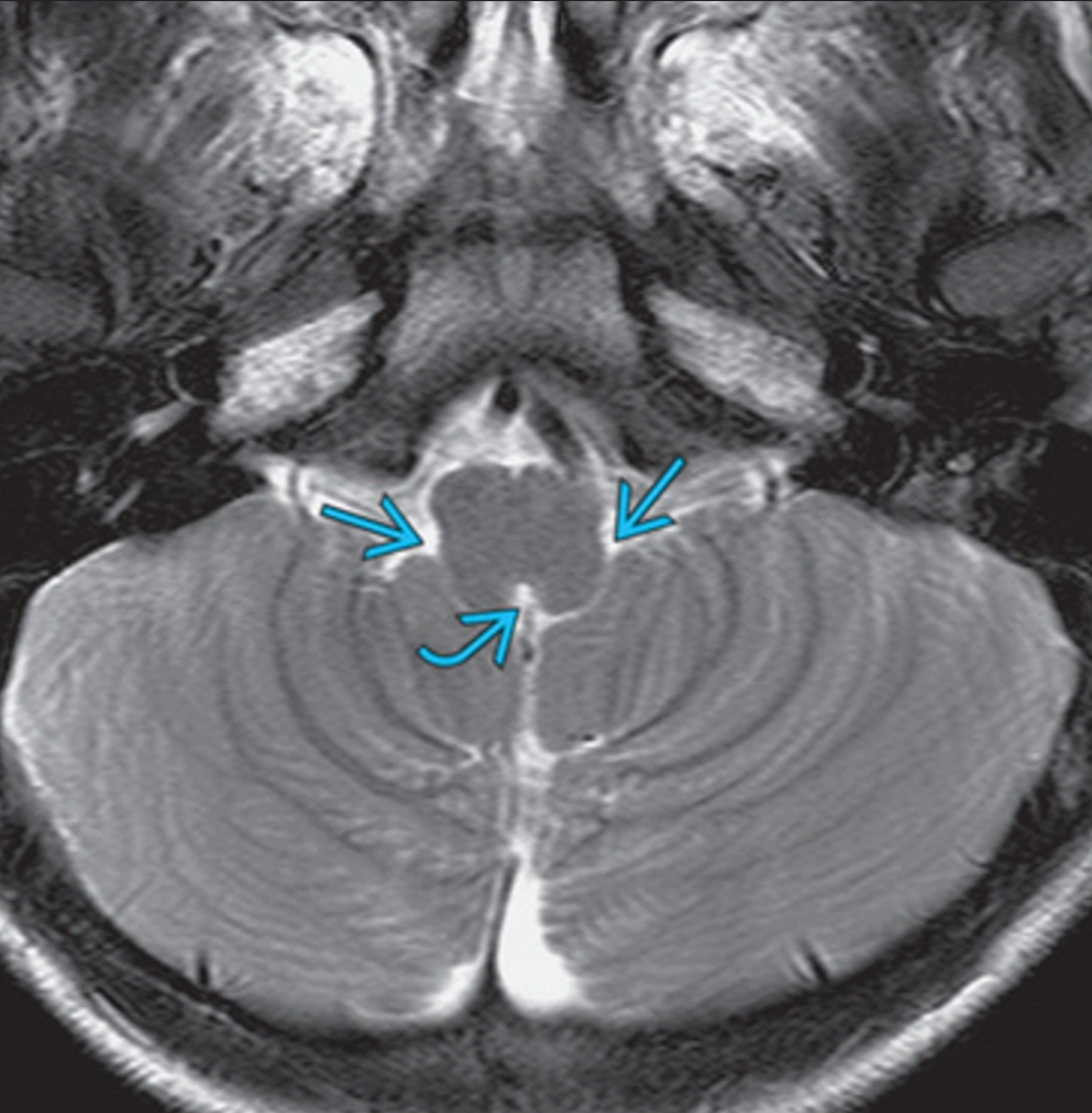 ventricular system overview Brain Imaging