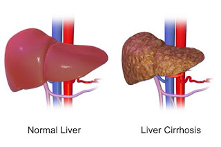 Home remedies for Liver disorders (cirrhosis)