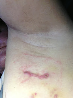 OMG! I have Breast Cancer!!! (aka Minogue's Mammary Monologues