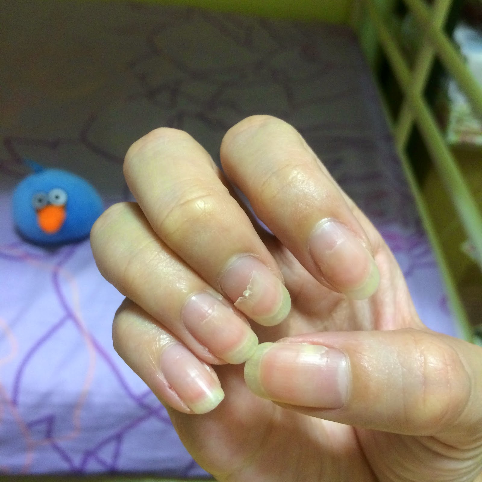 The Dettol Diaries Peeling Fingernails after HFMD