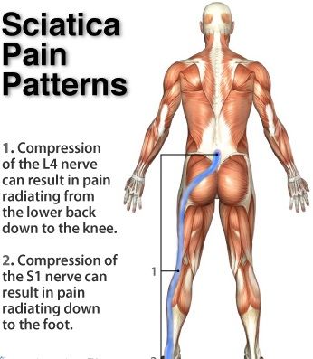 Sciatica Archives Insync Physiotherapy