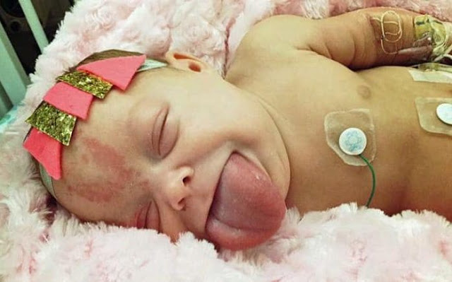 Lidah Bayi Ini DIpotong, Demi Bisa Tersenyum dengan Normal Lidah Bayi Ini DIpotong, Demi Bisa Tersenyum dengan Normal