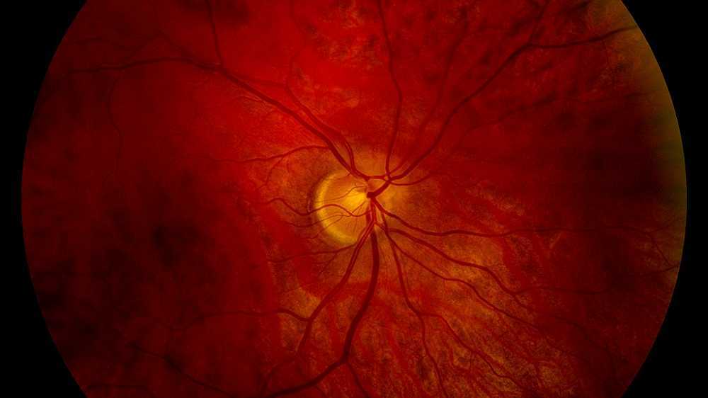 Optic nerve hypoplasia