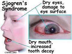 sjogren's-syndrome-details