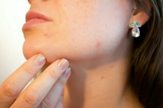  Setiap perempuan niscaya ingin mempunyai wajah yang higienis 11 Tips Ampuh Membasmi Jerawat Bandel