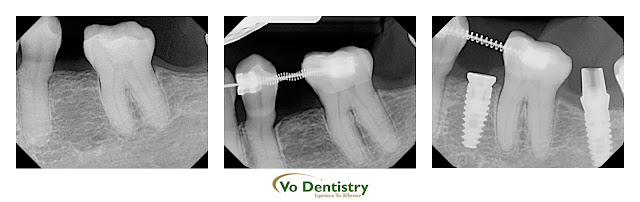 Dental implant, orthodontic treatment, cosmetic dentistry, Vo Dentistry, Immediate Implant, dental implant, inplants, Cosmetic Dentistry, same day implant, same day crown, Lawrenceville, Norcross, Lilburn, Dacula, buford, duluth, snellville, hamilton mill, grayson, sugar hill, sugar loaf, GA, Georgia, 30019, 30044, 30045