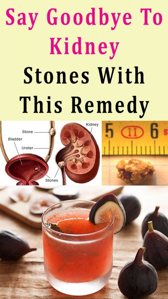 Say Goodbye To Kidney Stones With This Remedy HEALTH CAPSULES